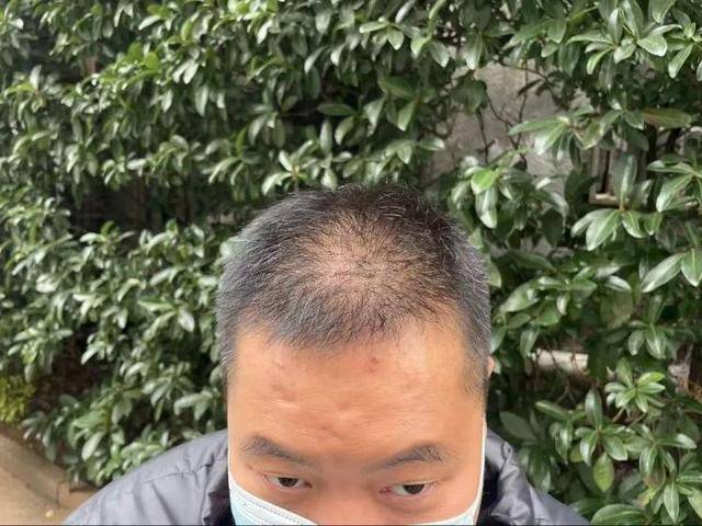 “还能反光<strong></p>
<p>XRP交易</strong>！”长沙男子植发近9月称后脑勺“像狗啃过”