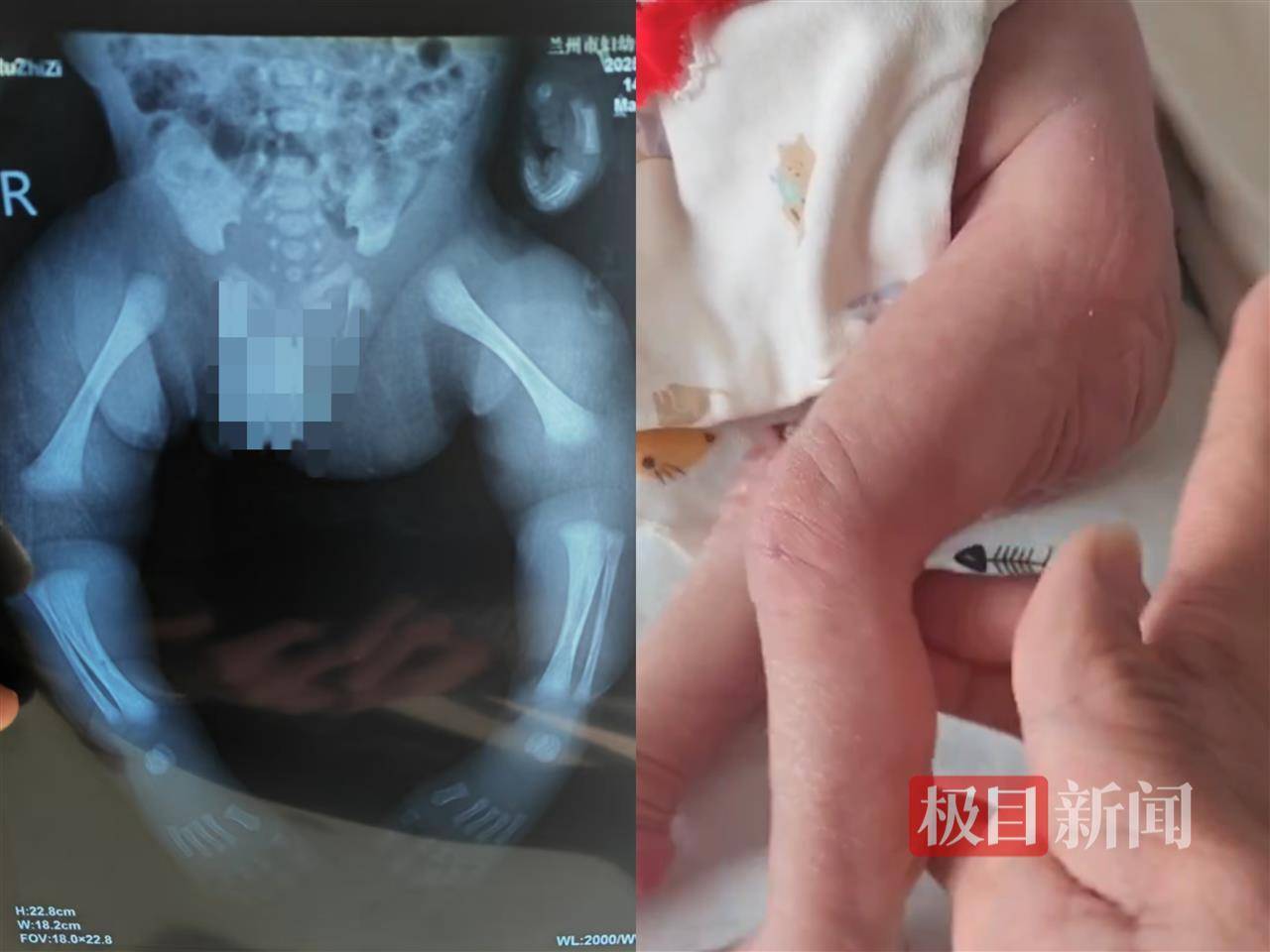 二胎出生查出先天性病症或落下残疾<strong></p>
<p>母婴</strong>，残疾父母称医院产检漏检、未尽告知义务，医院及医调委回应