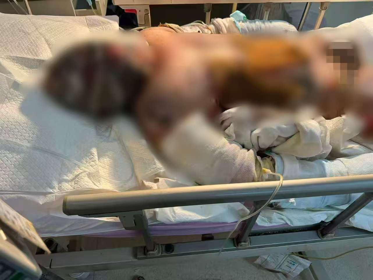 父子在哈尔滨一亲戚公司上班遇爆炸全身烧伤<strong></p>
<p>比特币儿</strong>，治疗花费近百万公司拒赔偿？亲戚回应