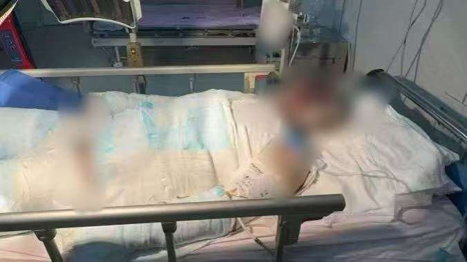 父子在哈尔滨一亲戚公司上班遇爆炸全身烧伤<strong></p>
<p>比特币儿</strong>，治疗花费近百万公司拒赔偿？亲戚回应