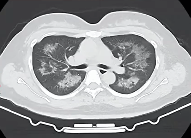 每天用2次<strong></p>
<p>rng虚拟币</strong>，22岁女主播肺里长满阴影！很多人不注意