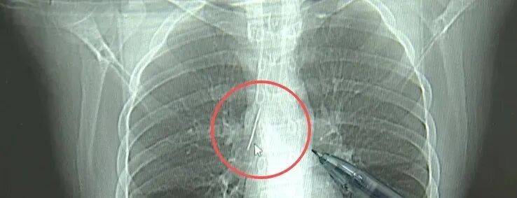 17岁小伙参军体检发现胸腔内有根5cm缝衣针<strong></p>
<p>中国出虚拟币</strong>，父母回忆或是1岁时扎入，取出时已锈迹斑斑