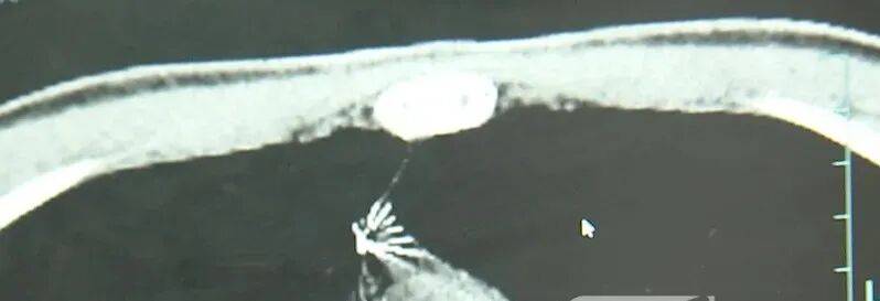 17岁小伙参军体检发现胸腔内有根5cm缝衣针<strong></p>
<p>中国出虚拟币</strong>，父母回忆或是1岁时扎入，取出时已锈迹斑斑