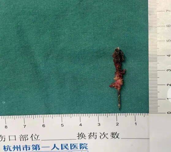 17岁小伙参军体检发现胸腔内有根5cm缝衣针<strong></p>
<p>中国出虚拟币</strong>，父母回忆或是1岁时扎入，取出时已锈迹斑斑